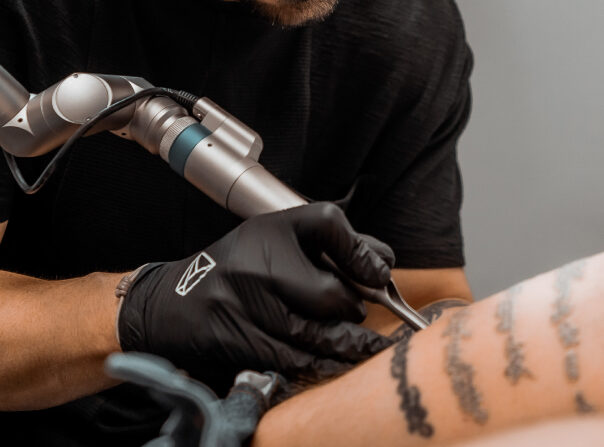 cómo eliminar tatuajes sin dolor