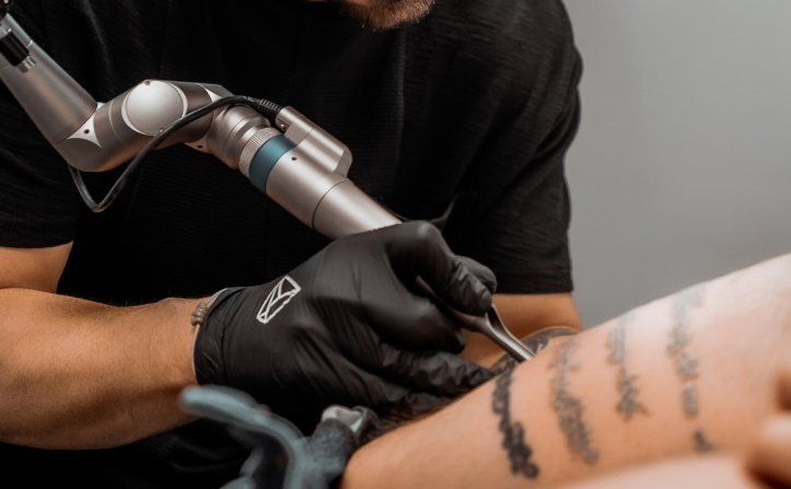 cómo eliminar tatuajes sin dolor