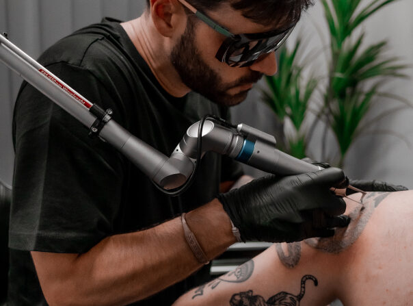 eliminacion de tatuajes con laser