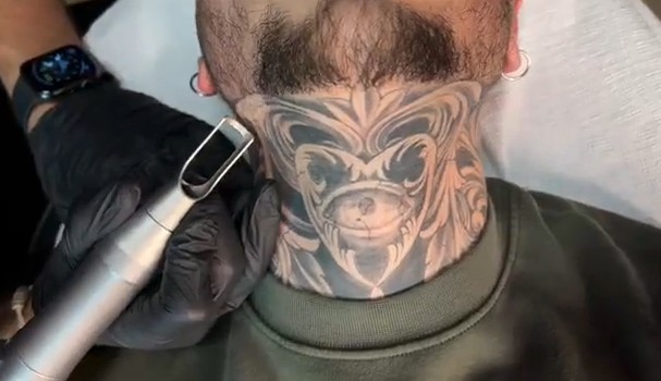 eliminar tatuaje duele