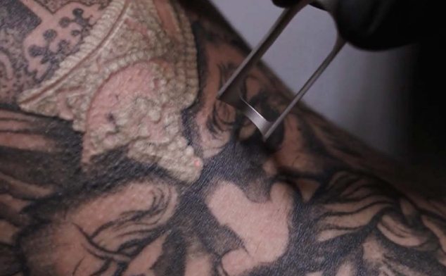 espera entre sesiones de eliminacion de tatuajes con laser
