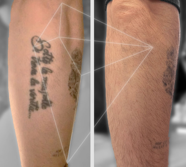 antes y despues eliminacion de tatuajes