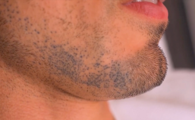 cómo quitar micropigmentación de la cara