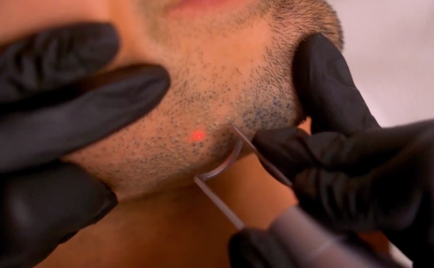 eliminar micropigmentación de la barba