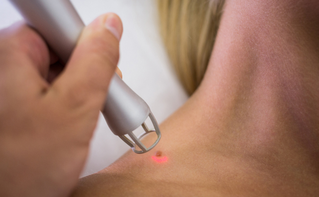 quitar lunares con laser CO2