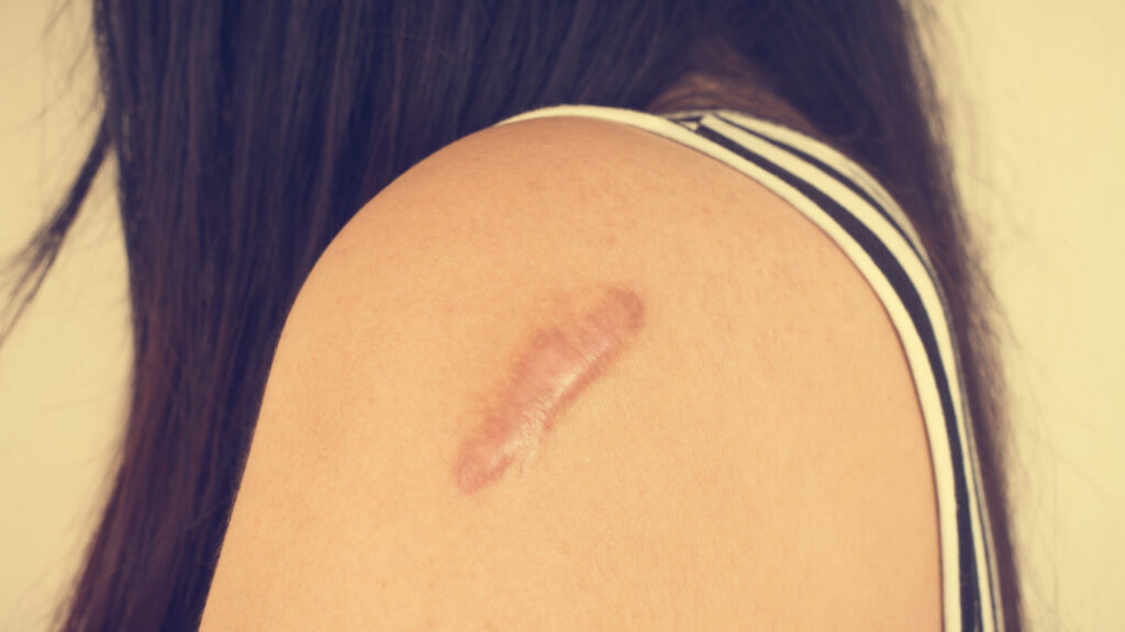 ampollas tras eliminar un tatuaje