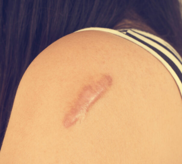 ampollas tras eliminar un tatuaje