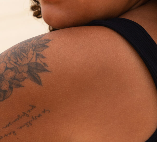 quitar tatuajes en pieles negras