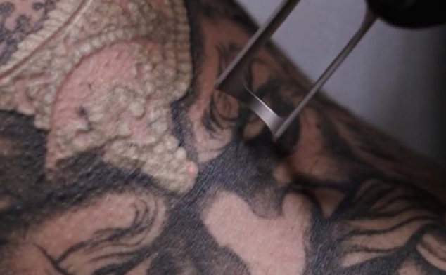 eliminar tatuaje láser opiniones reales