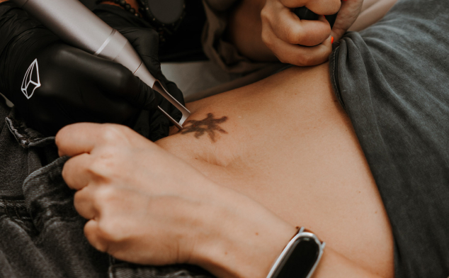 mitos eliminación láser tatuajes