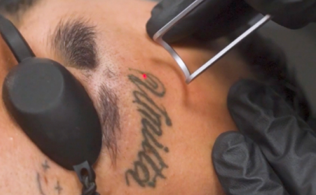 peligros láser tatuajes