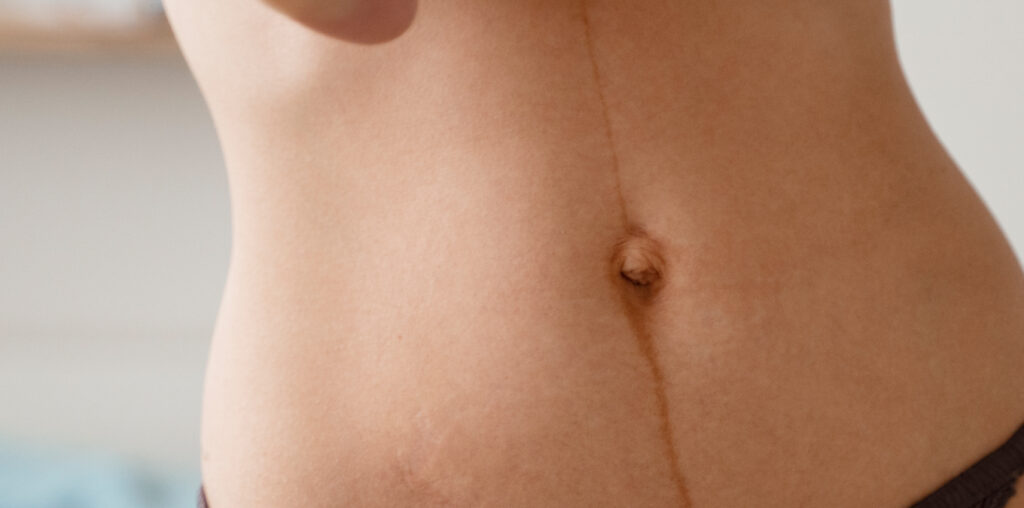 tatuar en cicatrices