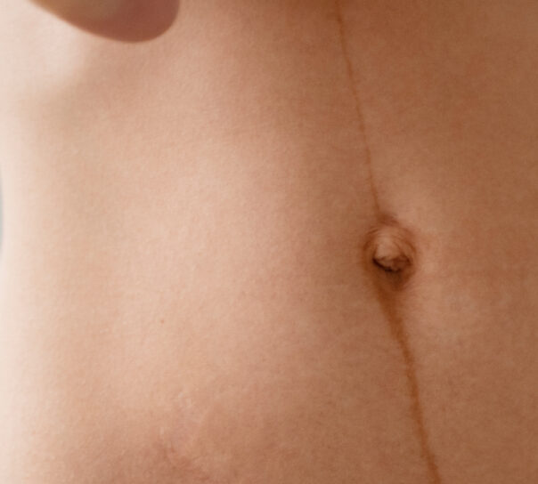 tatuar en cicatrices