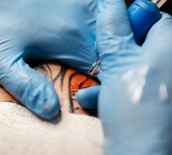 quitar tatuaje color rojo