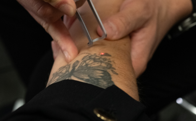 quitar tatuaje con cirugía